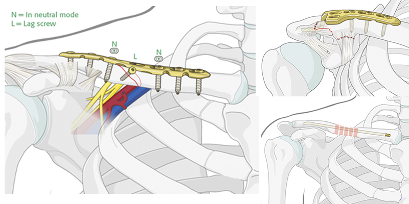Операция вставление пластины. Экстрамедуллярный остеосинтез. Остеосинтез ключицы пластиной. Остеосинтез при переломе ключицы. Остеосинтез ключицы операция.