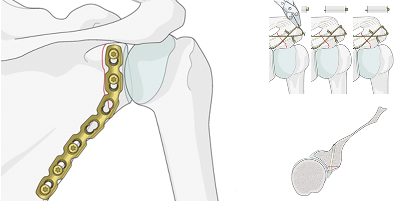 Классификация переломов лопатки рисунок