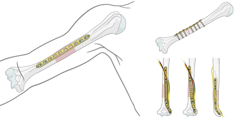 Операция после перелома плеча. Остеосинтез перелома плечевой кости. Остеосинтез перелома плечевой кости пластиной. Блокируемый интрамедуллярный остеосинтез биос. Остеосинтез при переломе плечевой кости.