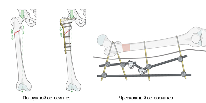 Накостный остеосинтез выполняют чем. Смотреть фото Накостный остеосинтез выполняют чем. Смотреть картинку Накостный остеосинтез выполняют чем. Картинка про Накостный остеосинтез выполняют чем. Фото Накостный остеосинтез выполняют чем