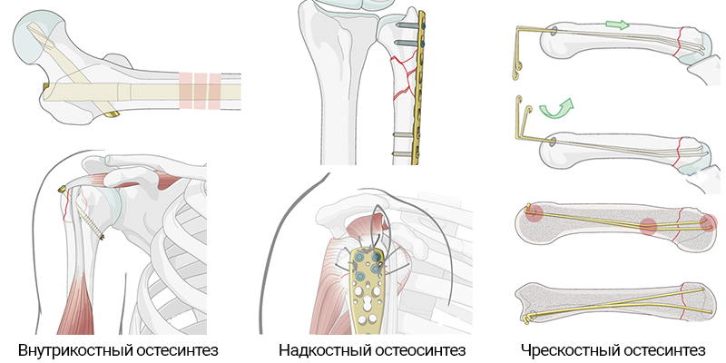 Накостный остеосинтез выполняют чем. Смотреть фото Накостный остеосинтез выполняют чем. Смотреть картинку Накостный остеосинтез выполняют чем. Картинка про Накостный остеосинтез выполняют чем. Фото Накостный остеосинтез выполняют чем