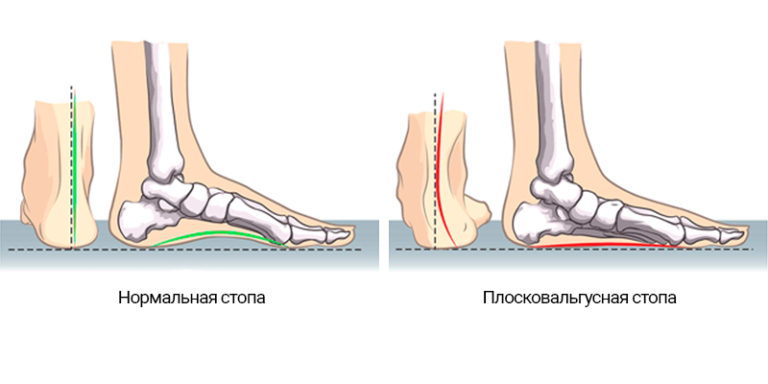 Поперечный распил стопы схема